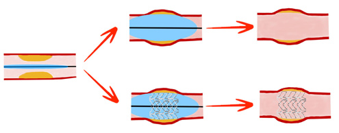Un ballon cathéter (avec ou sans stent) est introduit dans l’artère, entrainant ainsi son élargissement, la compression de la plaque et l’augmentation de la circulation sanguine.