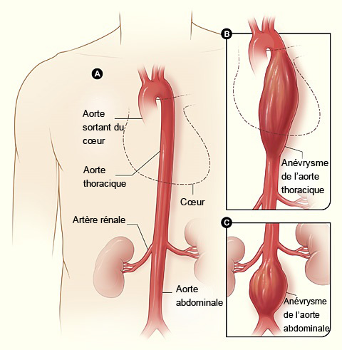 Un anévrisme artériel est une dilatation d’une artère, le plus souvent l’aorte abdominale, consécutive à la faiblesse de sa paroi.