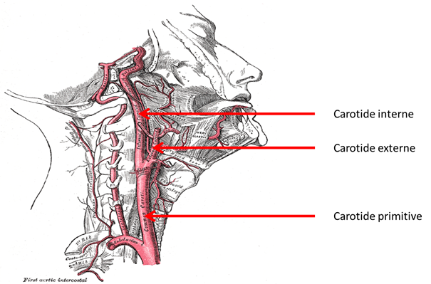 La maladie occlusive ou sténose de l’artère carotide, est un rétrécissement du calibre des artères carotides.