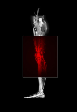 L’artériopathie oblitérante des membres inférieurs (AOMI) entraine une diminution du flux sanguin vers les extrémités.