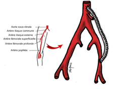 Le pontage est une technique chirurgicale consistant à créer une dérivation, afin de rétablir une circulation sanguine correcte.
